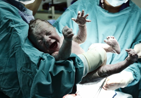 c-section-600x420